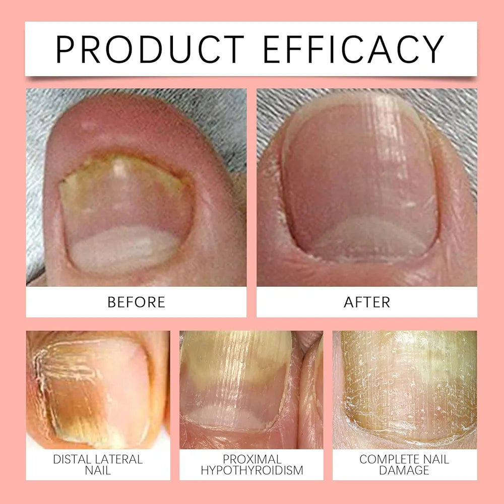 Pack 21 Parches Reparadores Uñas Hongo